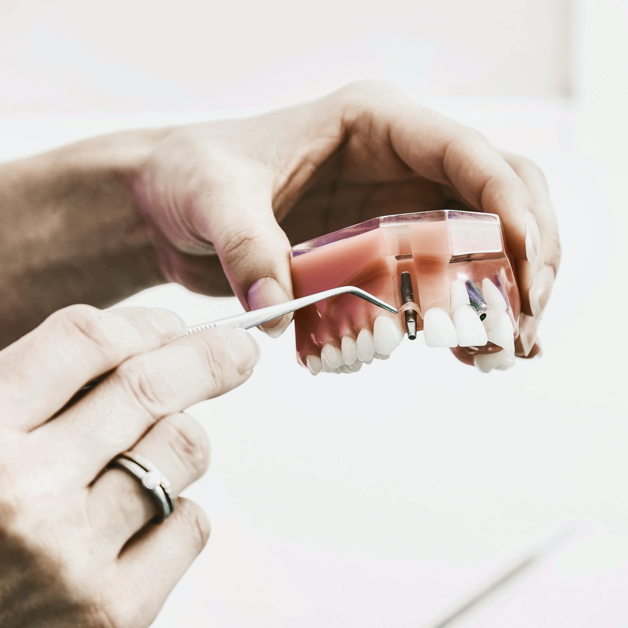 hochzwei_ddd_teaser_04.jpg Weibliche Hände zeigen Schrauben in einem Zahnmodell