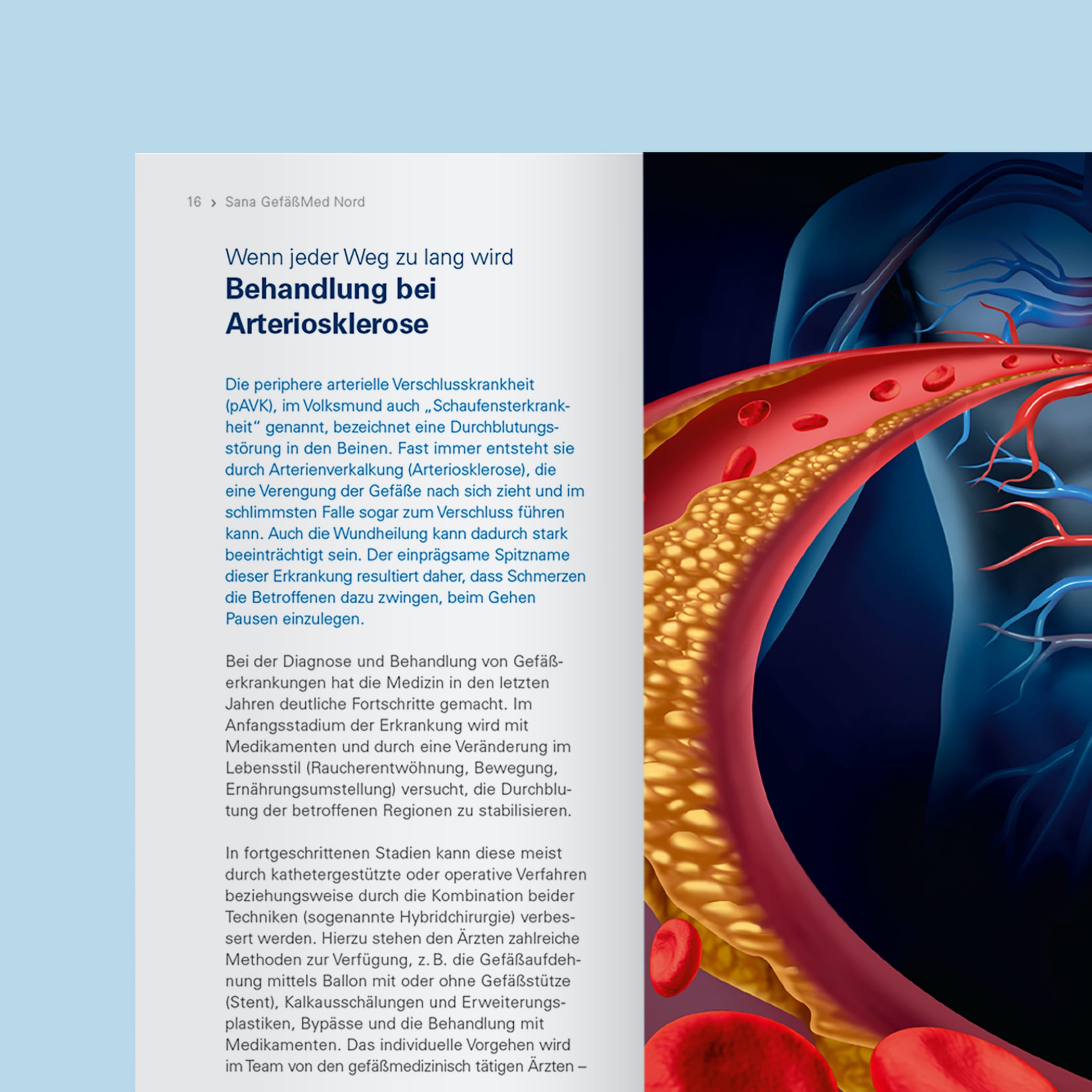 hochzwei_sana_teaser_07.jpg Artikel über Artiosklerose mit einem Bild